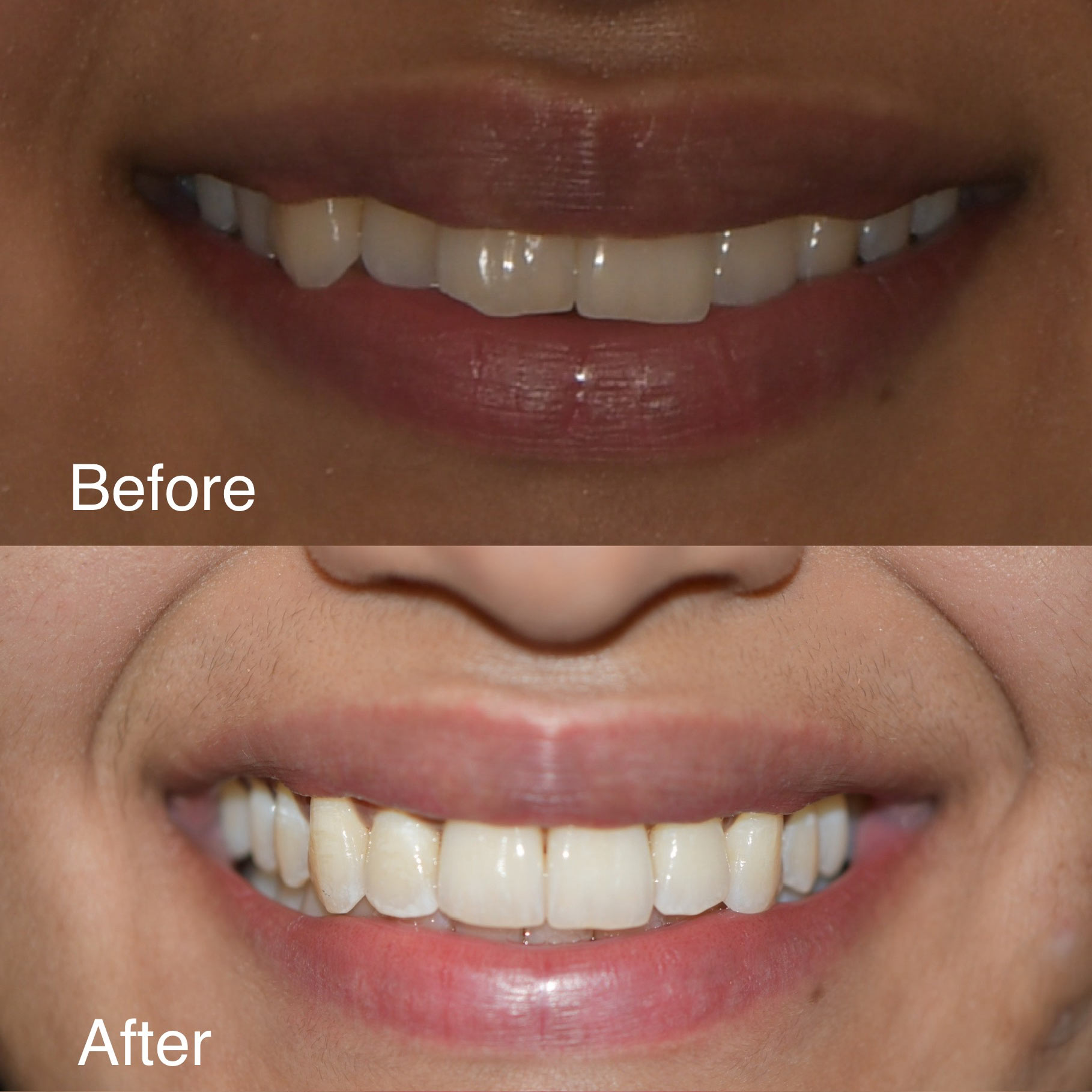 Invisalign Before Afters