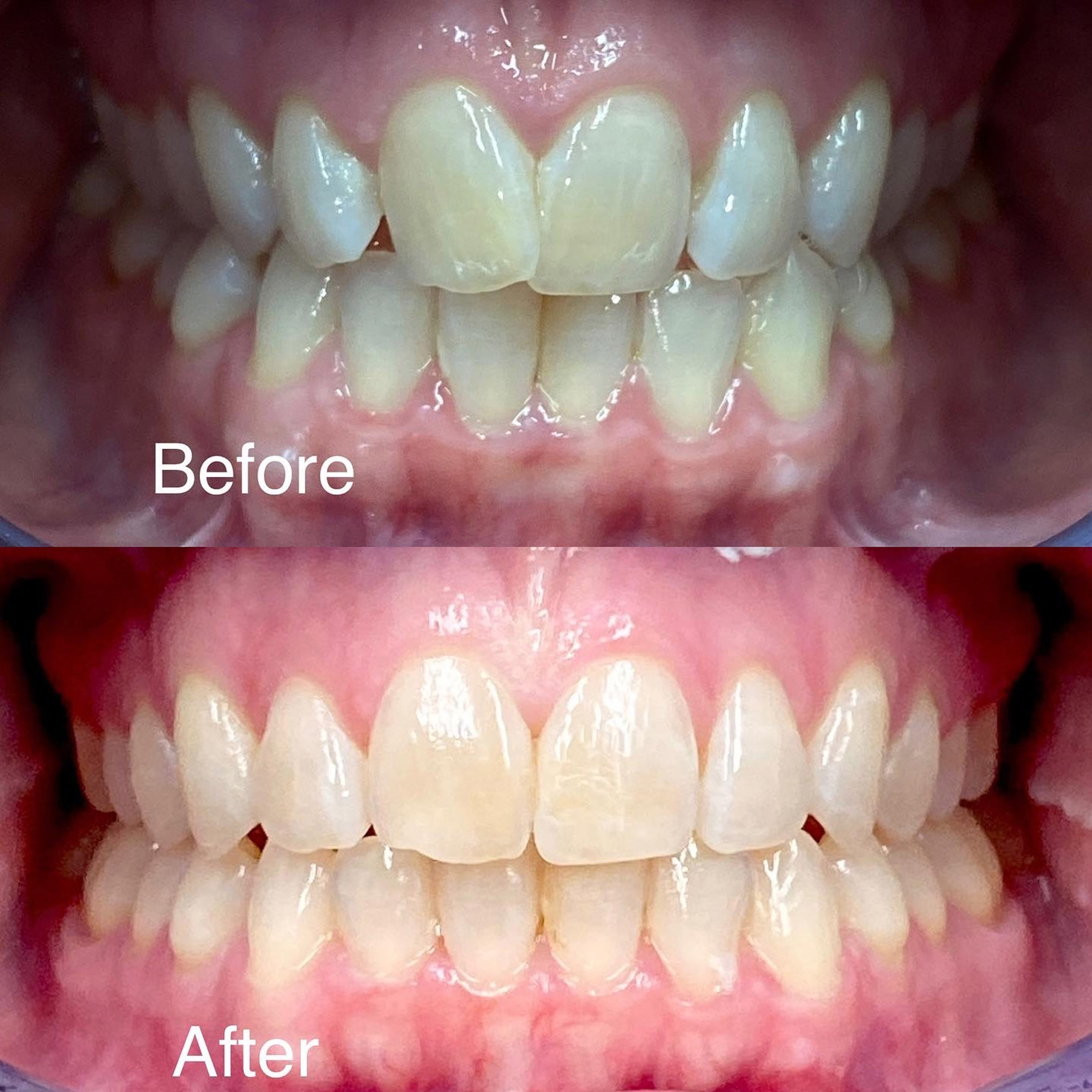Invisalign Before Afters
