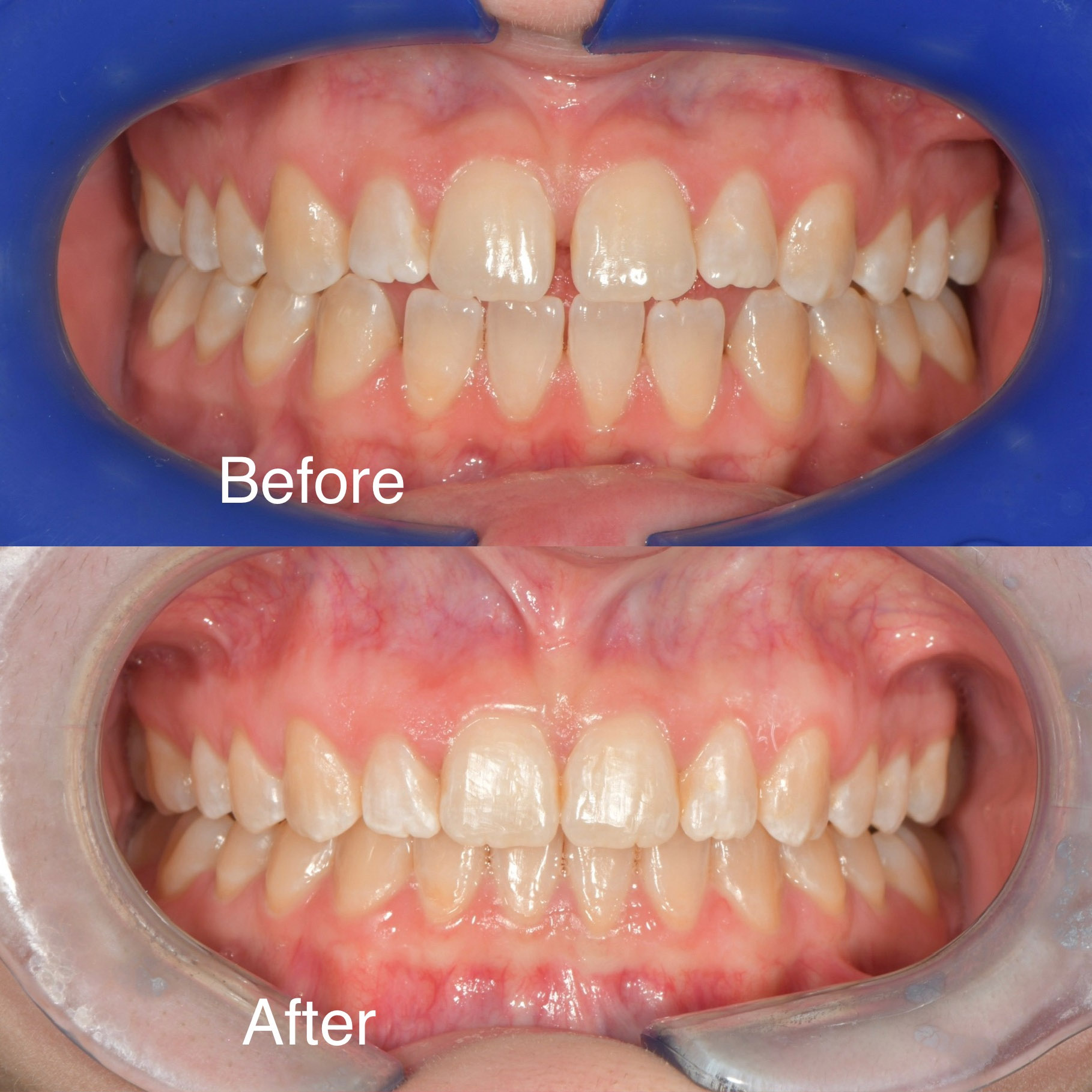 Invisalign Before Afters
