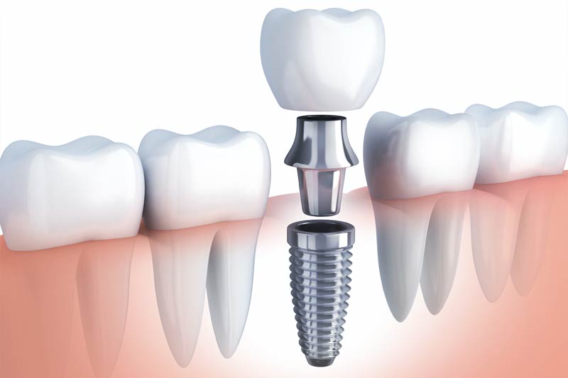 	York Road Dental Care and Implants Special Offer