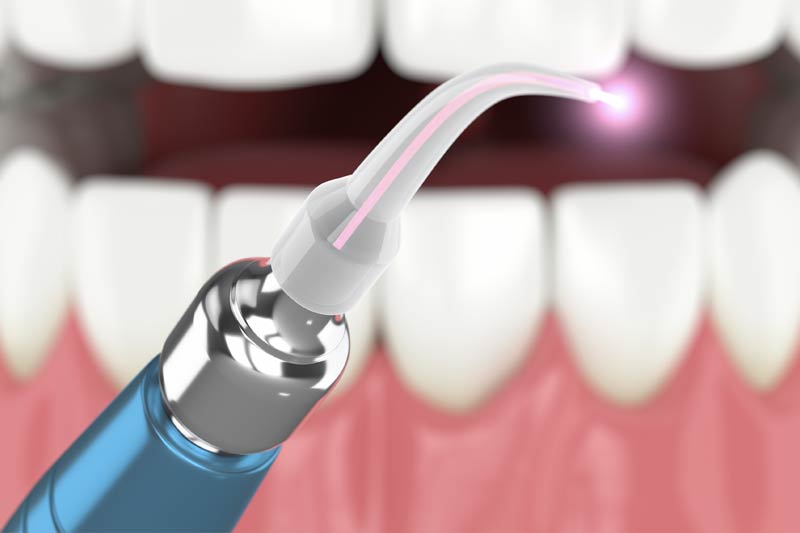 Laser Dentistry in Lutherville-Timonium